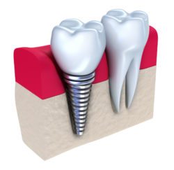 dental implants longmeadow ma