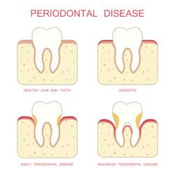 periodontal therapy longmeadow ma
